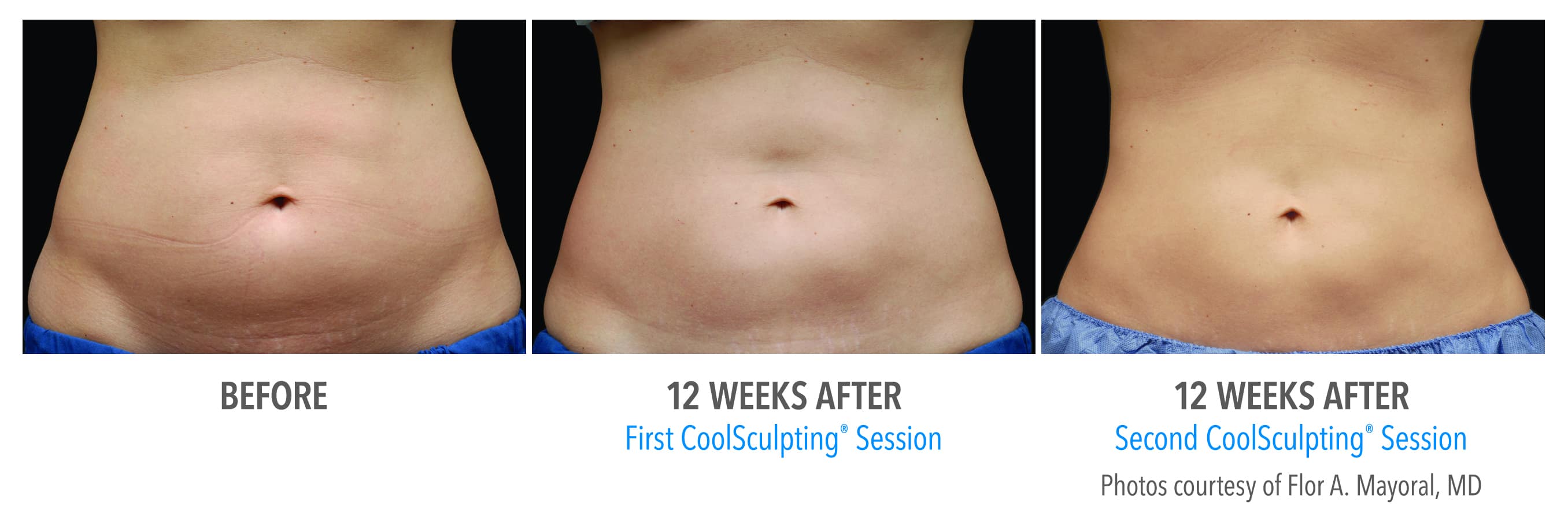 Coolsculpting Coolsculpting