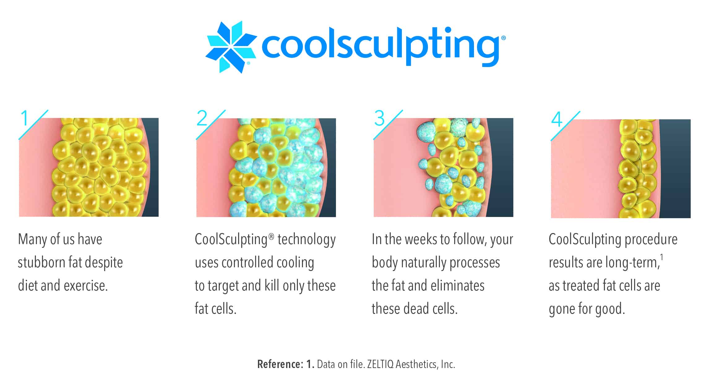 Coolsculpting Coolsculpting